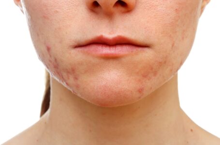 Cildinizi COVID-19 maskelerinin yarattığı “maskne”ye karşı korumanız mümkün!